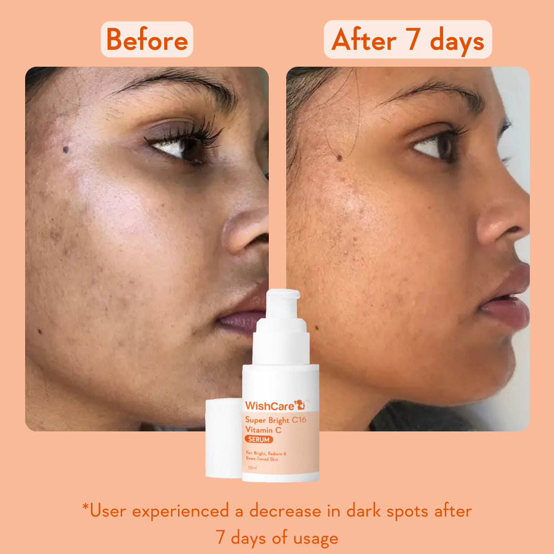 before and after images showing how this is effective to remove dark spots on face