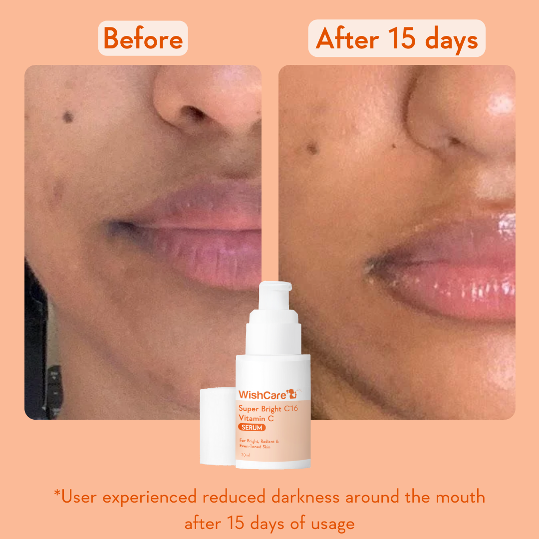 before and after images showing how this is effective to reduce pigmentation around mouth