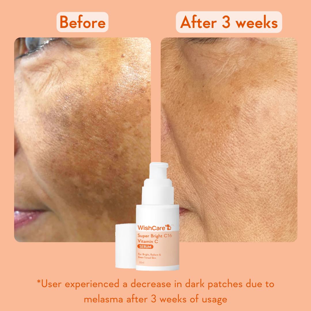 before and after images showing the benefits of using the best vitamin c serum to reduce melasma and pigmentation