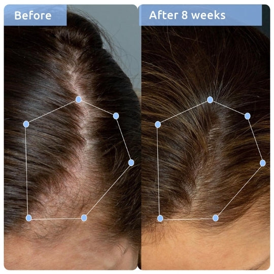 picture describing the difference after using hair fall control shampoo and hair growth serum combo